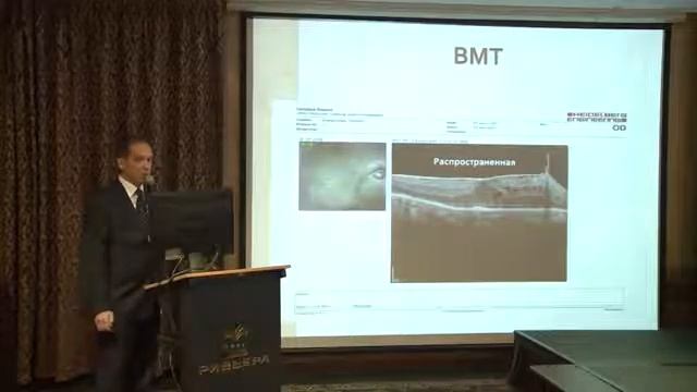 Retinal Disease. Классификация заболеваний витреомакулярного интерфейса. смотреть онлайн