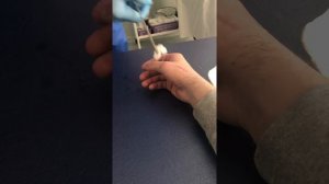 Вытаскивают спицы после перелома