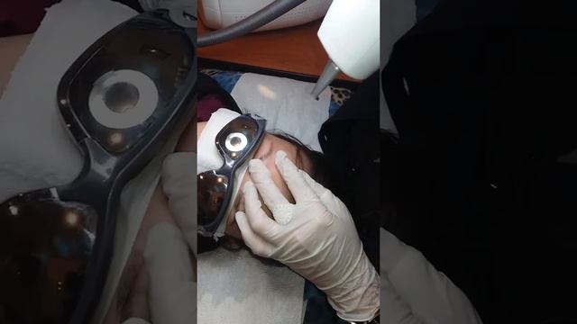 Лазерное удаление татуажа бровей по постоянной акции до конца года смотреть онлайн