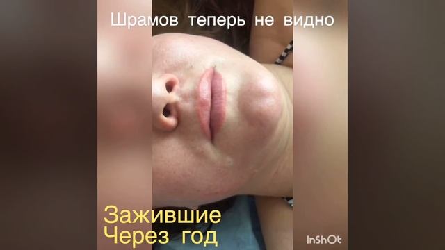 Заживший татуаж губ через 1год, 1процедура смотреть онлайн