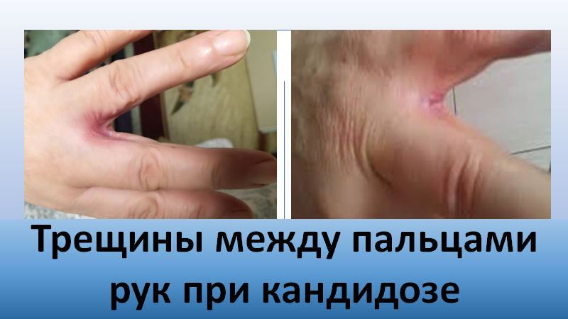 Трещины между пальцами рук при кандидозе смотреть онлайн