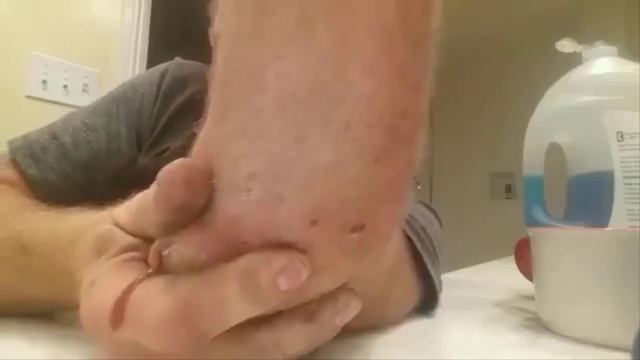 Remoção de cravo 2021 - Pimple Popping 2021 -Blackhead Removal EP005 смотреть онлайн