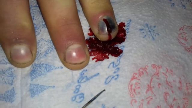 Прищемил ноготь. Лечение в домашних условиях