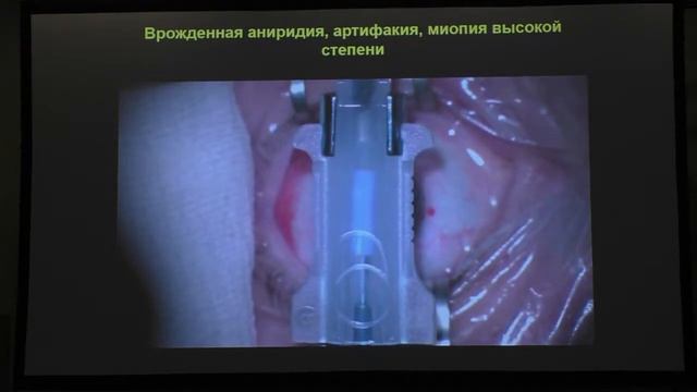 Имплантация искусственной радужки в афакичный глаз с врождённой аниридией смотреть онлайн