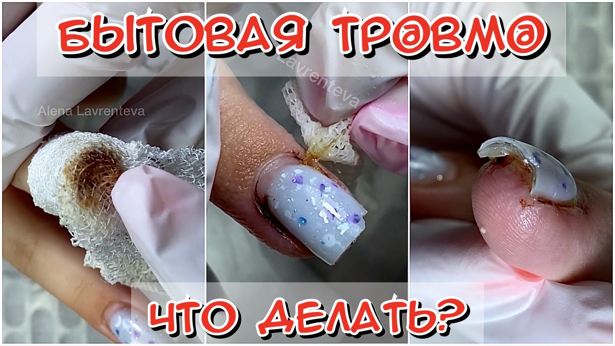 Бытовая травма ? - что делать?