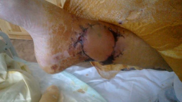 Перелом и пересадка кожи смотреть онлайн