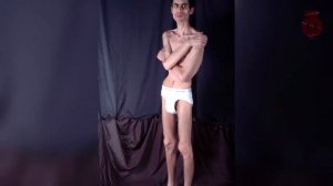 Топ 5 самые худые люди