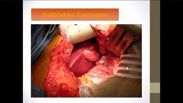 (GIT) SURGERY Signs and symptoms of patients with Gall bladder cancer смотреть онлайн