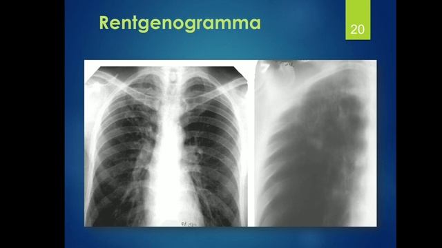 O‘choq tuberkulyoz kasalligi Infiltrativ tuberkulyoz Kaziozli смотреть онлайн