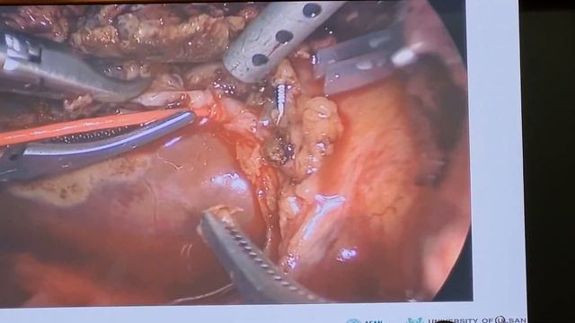 Ki Hun Kim liver transplantation 1 смотреть онлайн