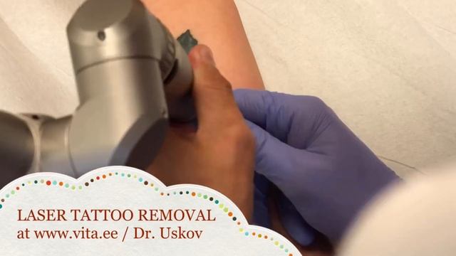 Värvilise tatoveeringu eemaldamine Удаление цветных татуировок Colour tattoo removal смотреть онлайн