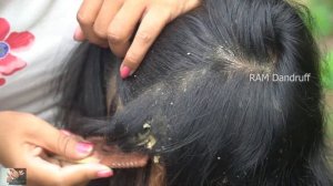 Psoriasis treatment - Huge Flakes, Dandruff Scratching #151