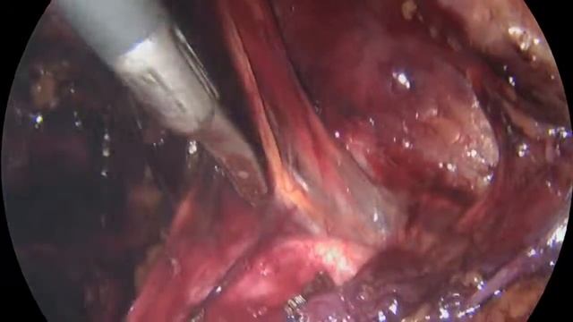 Паховая грыжа ТEP Pro Grip смотреть онлайн