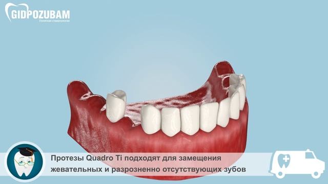 Съмные зубные протезы: съемный зубной протез Quadro Ti смотреть онлайн