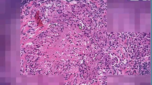 Histopathology Lymph node --Tuberculosis смотреть онлайн