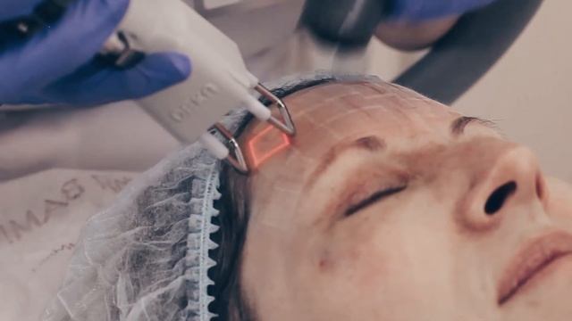 Лазерная шлифовка лица + плазмотерапия смотреть онлайн