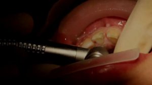 Препарирование зубов под коронки