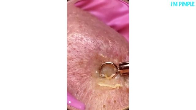 Popping Giant Pimple & Popping Huge Blackheads - Best Pimple Popping Video #58