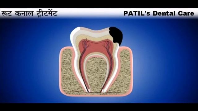 Root Canal Treatment Hindi || रूट कैनाल ट्रीटमेंट смотреть онлайн