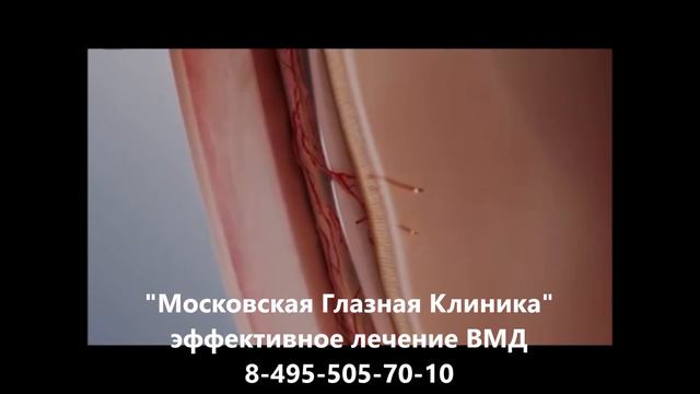 Влажная форма ВМД (возрастной макулярной дегенерации сетчатки) смотреть онлайн