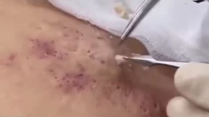 Popping huge blackheads and Giant Pimples - Best Pimple Popping Videos #75