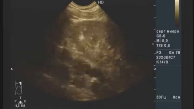 Множественные ангиомиолипомы смотреть онлайн