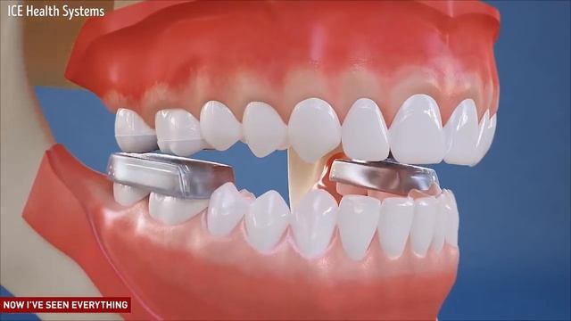 Лечение открытого прикуса окклюзионными накладками в боковых отделах смотреть онлайн