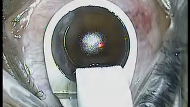 LASIK [CustomVue] BY DR PANKAJ ANANTWAR NAGPUR, INDIA.webm смотреть онлайн