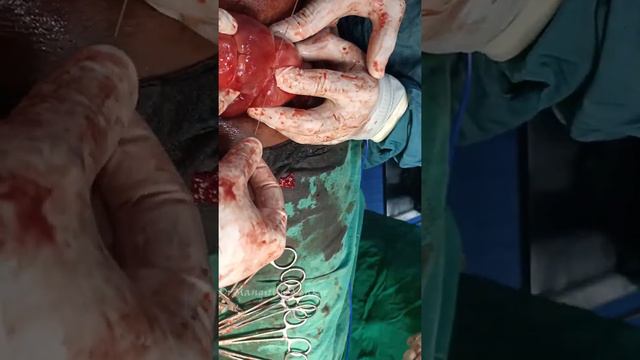 Hayman Compression Suture ( Alternative To B-Lynch)