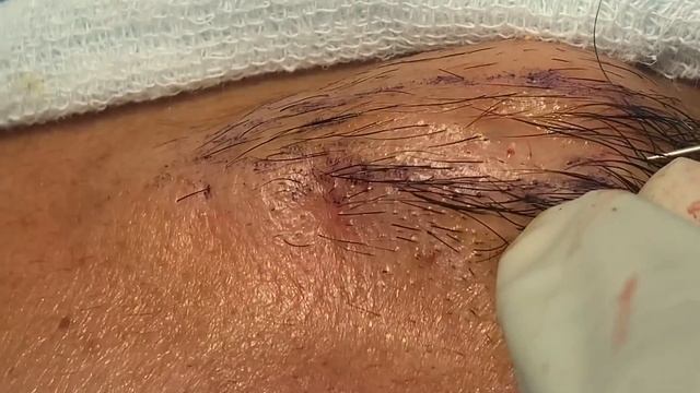 How To Get Permanent Designer Eyebrows - Hair Transplantation