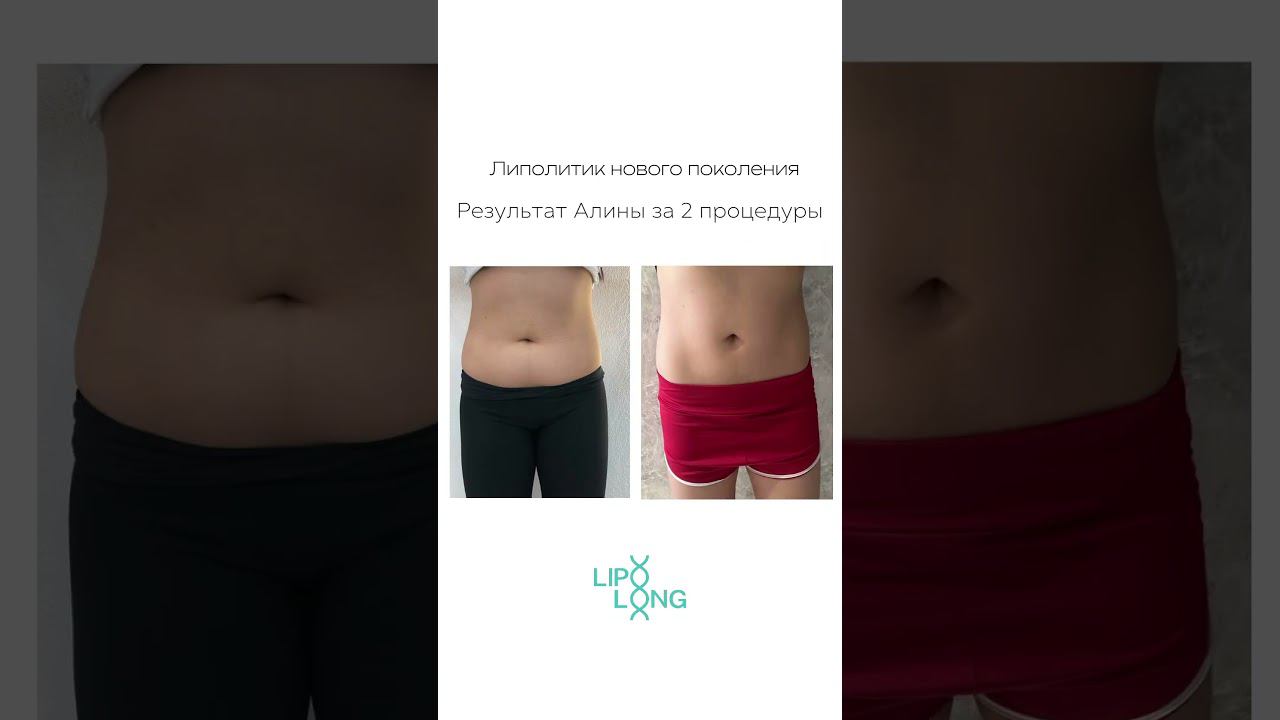 Похудеть быстро и безопасно  Провели 2 процедуры. Результат: плоский животик без диет и физ нагрузок