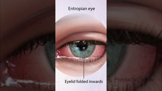 Entropion | ఎన్ట్రోపియాన్ | смотреть онлайн