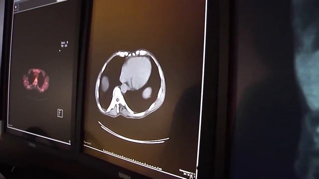 Diagnosing cancer with PET scans смотреть онлайн