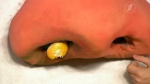 Инородный предмет в носу. Как его извлечь