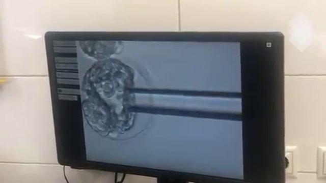 Биопсия трофобласта - выявление возможных генетических заболеваний у эмбриона смотреть онлайн