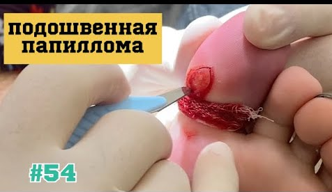 54. Хирургическое удаление подошвенной папилломы