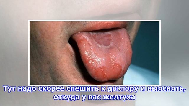 Что означает налёт на языке и как от него избавиться смотреть онлайн