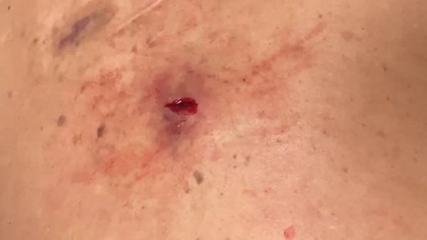 I “tap” the deep pocket of purulence on his back and it flows out relieving the pressure. Happiness