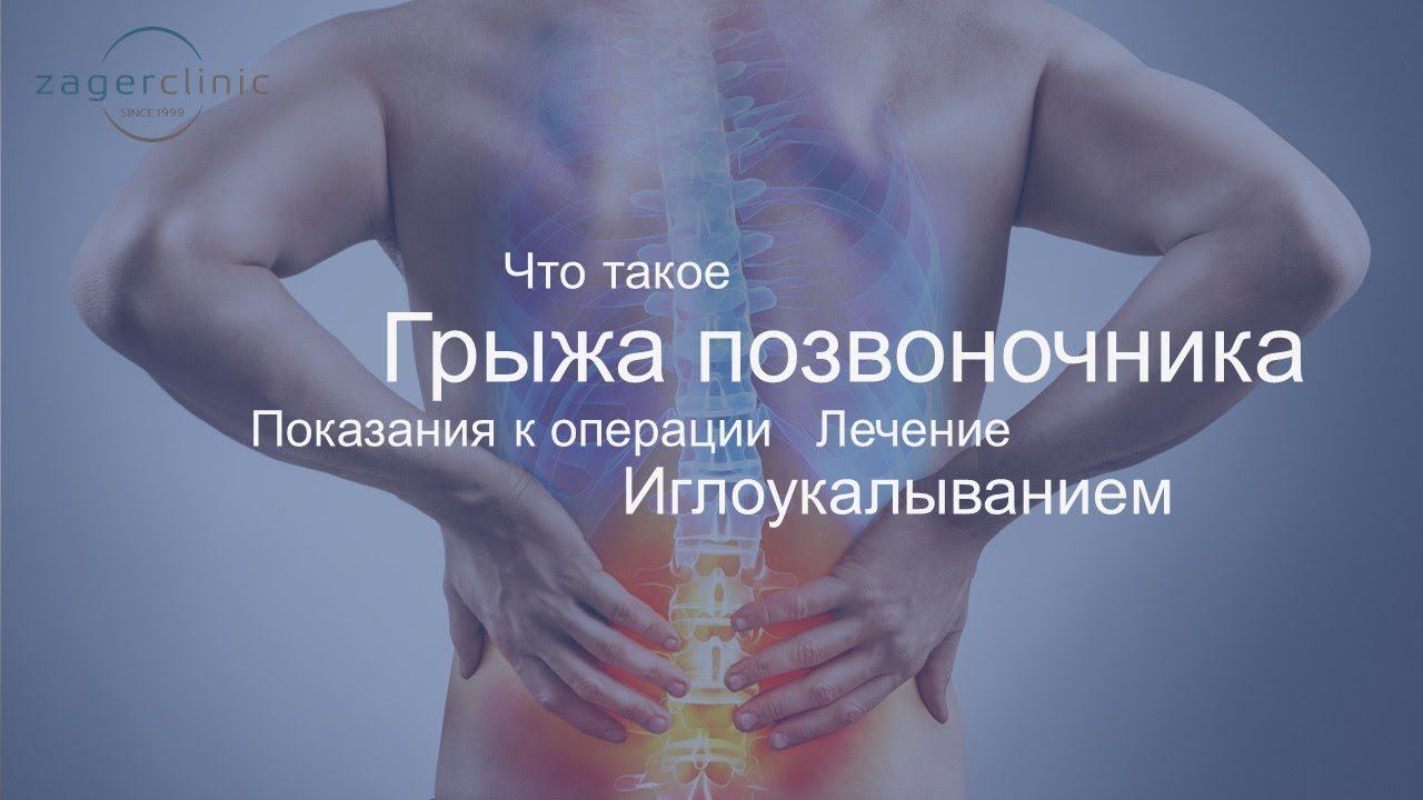 Что такое грыжа позвоночника | Лечение иглоукалыванием смотреть онлайн