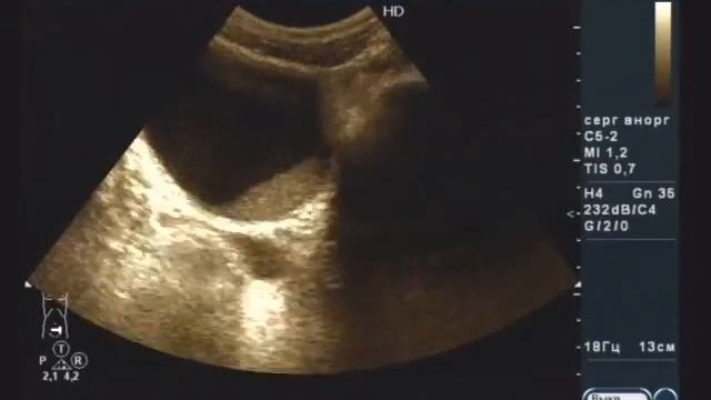 Эхогенный осадок в мочевом пузыре смотреть онлайн