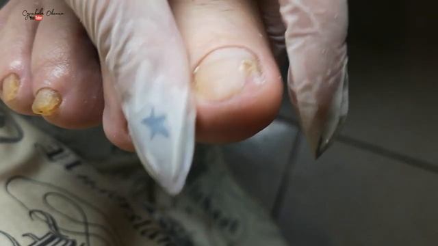 Утолщение ногтей и онихолизис из-за деформации пальцев ног. Зачистка онихолизиса и педикюр пальцев смотреть онлайн