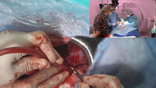 Шунт в печени 3 штуки Как одна печень выдерживает три шунта?