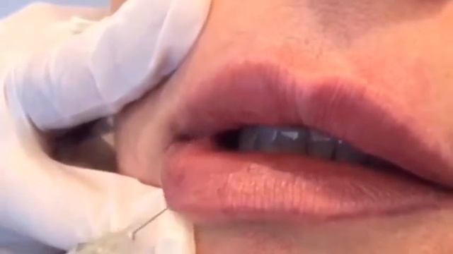 Lip Filler | Renew Cosmetic