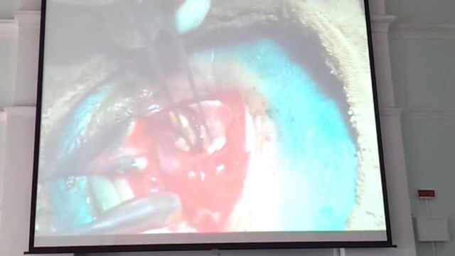 Конъюнктивит. смотреть онлайн