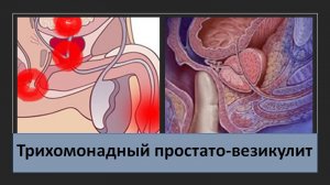 Трихомонадный простато-везикулит.
