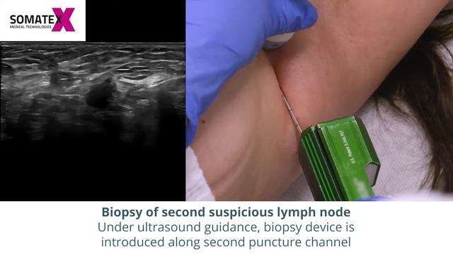 Axillary lymph node biopsy low смотреть онлайн