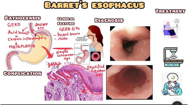 Barret’s Esophagus made simple for USMLE, NEET PG, NCLEX смотреть онлайн