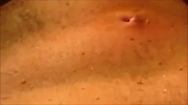 Огромный гнойный чирей/Huge purulent furuncle смотреть онлайн