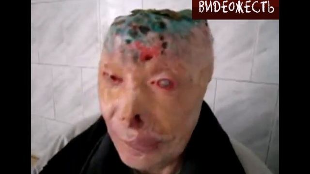 Gunther disease, Болезнь Гюнтера смотреть онлайн