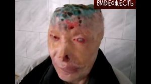 Gunther disease, Болезнь Гюнтера